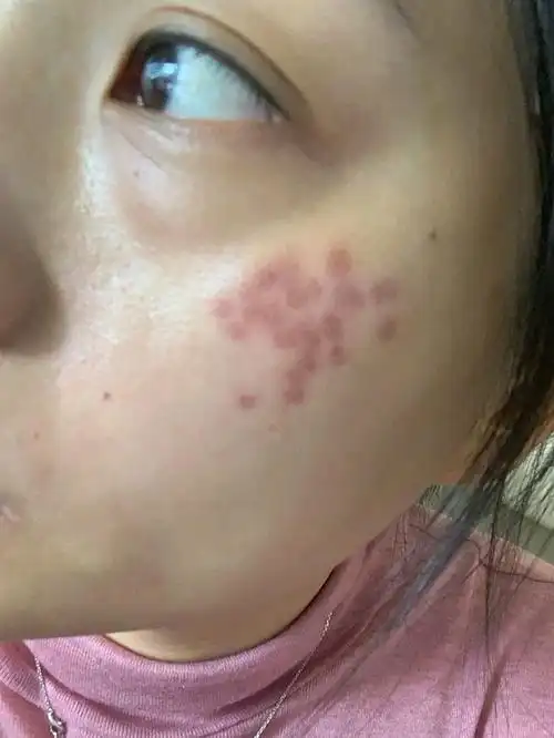 后天颧骨上长了青褐色斑,不管是先天的还是后天的,反_圈子-新氧美容