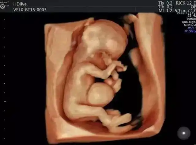 孕妈妈的福音美国e10四维彩超胎儿排畸王者落户漳州市华侨医院