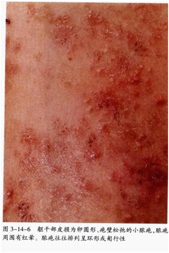 花斑癣型:较少见,为色素减退或不同程度棕色色素沉着性扁平鳞屑性丘疹