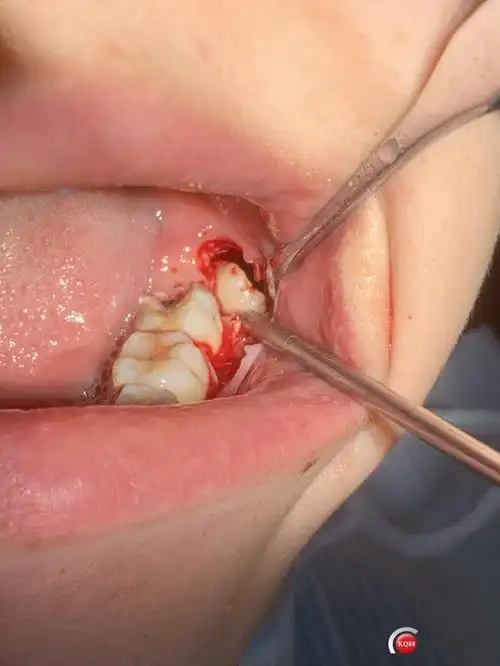 颊舌向阻生智齿拔除1例