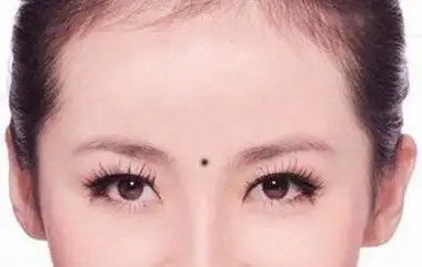 所以整体来说,眉心长痣的女人病没有什么旺夫相,如果是长的朱砂痣,那