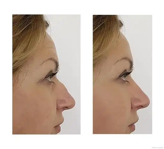 女人鹰钩鼻的面相运势好吗