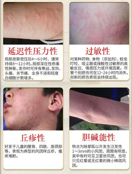 寻荨l麻疹乳膏湿l疹抑l菌止l痒湿l毒风团汗l孢疹过敏瘙l痒