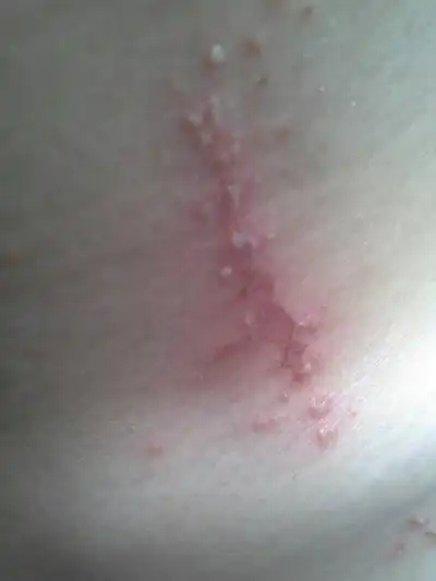 虫咬性皮炎图片 (109)_有来医生