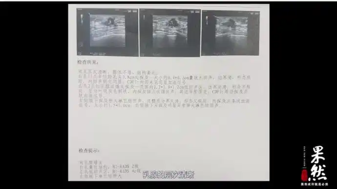 拿到乳腺彩超单不要慌枣庄妇幼保健院专家教你解读