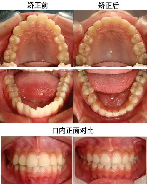 山东牙齿矫正医学类型:深覆盖, 牙列拥挤矫正方法:固定矫正, 拔牙, 支