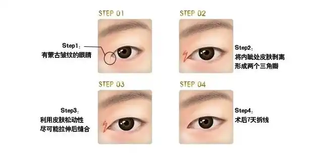 严重的内眦赘皮或伴发邻近部位畸形者需要手术矫正