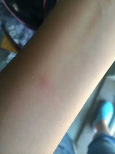 问:肺结核试敏实验,过了一天是照片上的样子,针眼处有小硬结周围不肿