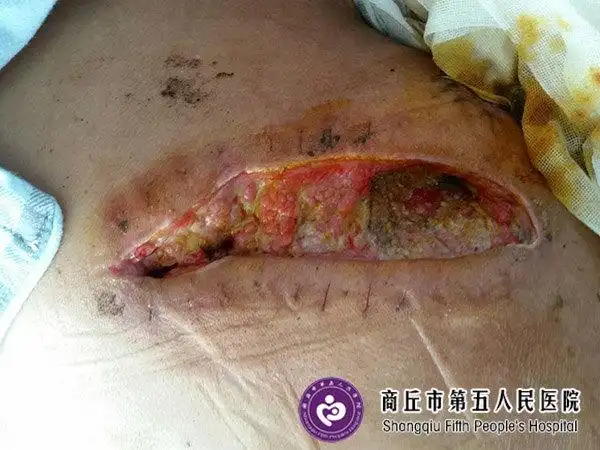 分析主要是手术后伤口处理不当,导致受到了感染,没有及时正确处理造成