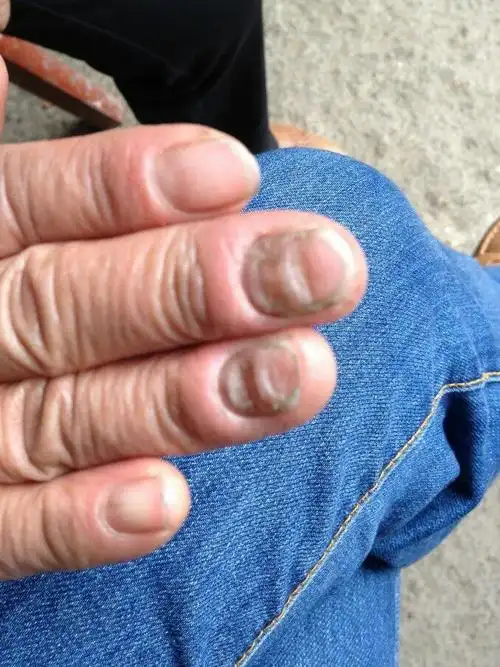 其它 当心,您的指甲凹凸不平 如何预防手指甲凹凸不平?