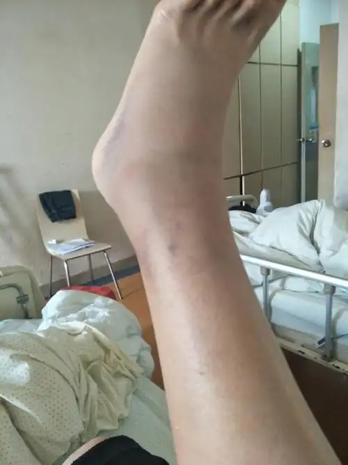 左脚踝骨折,骨裂,手术上钢板