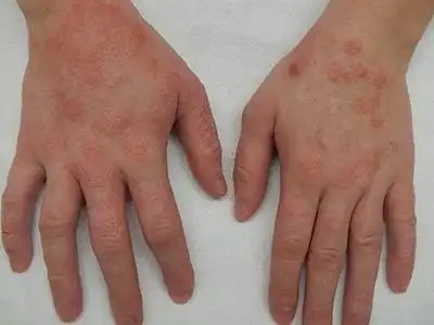 艾滋病感染性皮肤损害手背红色丘疹图.jpeg