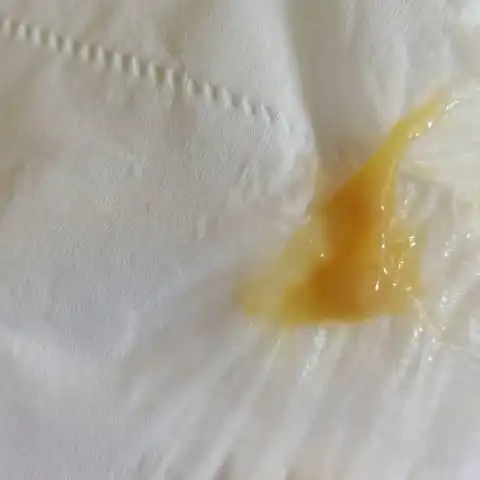 育儿问答 怀孕期 孕33周,今天分泌物变多,很黄,而且粘稠的那种