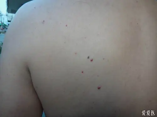 泛发性樱桃状血管瘤