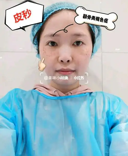 现场直击-超皮秒神奇祛斑!