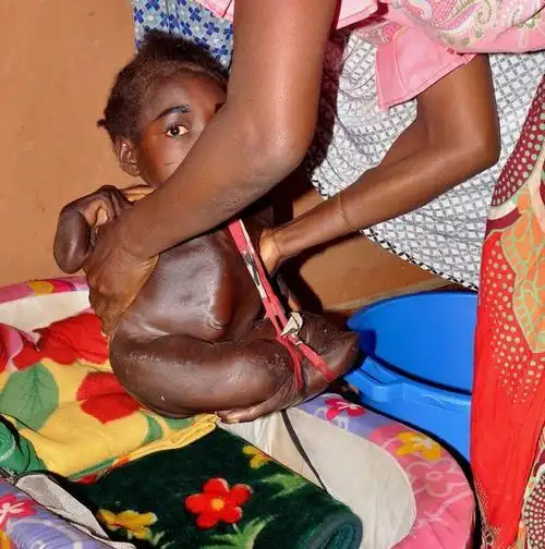 这个女孩出生后只有头能发育医生的建议让父母无法接受