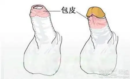 龟头炎的诊断要如何做好呢?