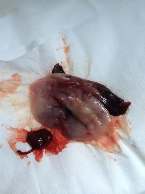 月经第一天,排出白色和肉块一样的东西,是什么,以前没有出现过白色的