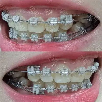 陶瓷半隐形托槽矫正器佩戴