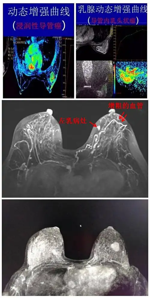 磁共振检查对恶性肿瘤的敏感度比较高,通过时间剂量曲线能够让医生对