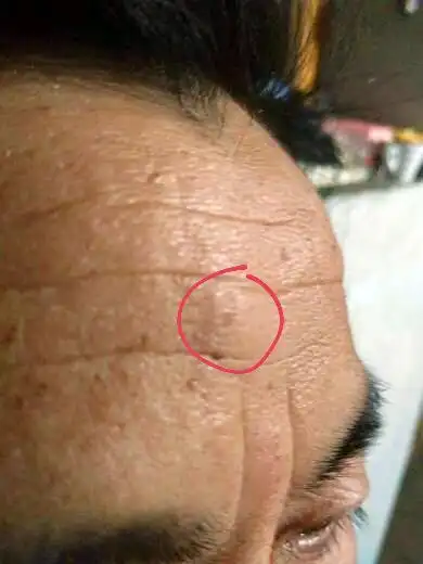 额头中间有个包,很硬,像是骨头,这是什么?