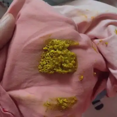 各位宝妈,刚满月婴儿大便这样正常吗?母乳喂的_宝宝树