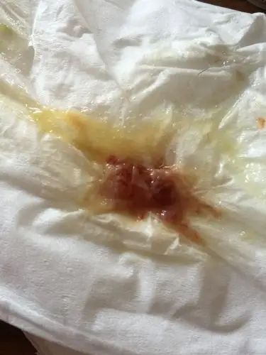 有点感冒 今早擤鼻涕 鼻子里出来了图片里的东西 是什么啊