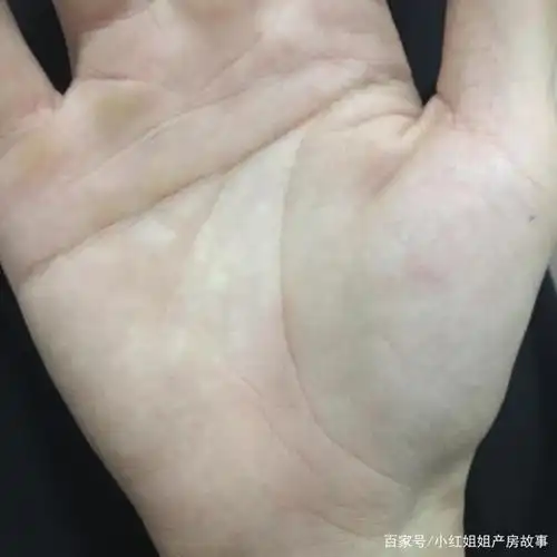 刚出生的婴儿手掌有贯通掌纹,怎么判断是不是唐氏儿?