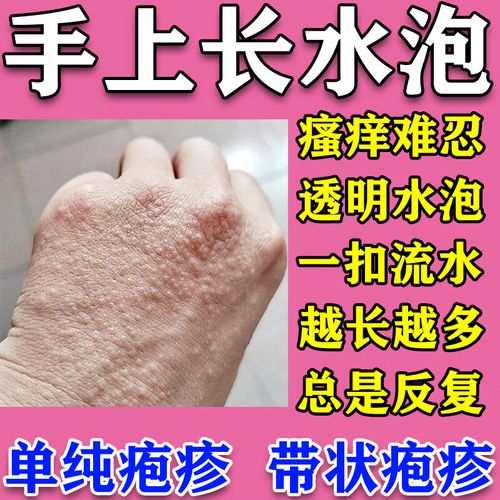 汗疱疹药膏手上起小水泡脱皮手痒皮肤瘙痒手脱皮膏真菌感染手皮开裂