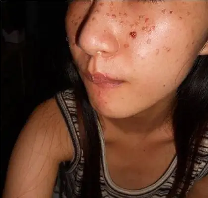 激光祛斑后反黑图片6