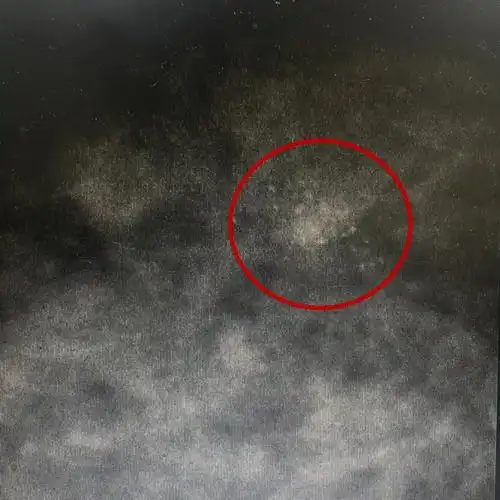 双侧乳腺疼痛2年增生结节钙化