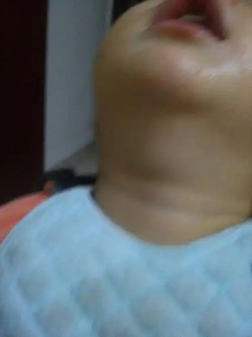 宝宝两岁男,今天发现喉咙上方鼓很大一个包,,像里面鼓出来的.