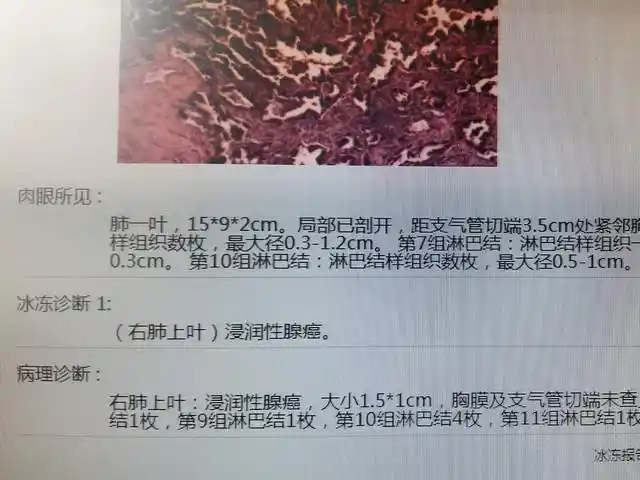 苏州九龙医院多科联手开展微创手术,助市民摆脱早期肺癌困扰