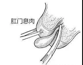 肛门口脱出个"肉肉",这种经历你也有过吗?或不是痔疮那么简单