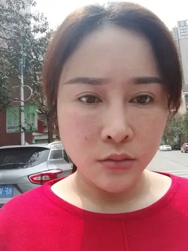 填充泪沟第10天这是不是失败了