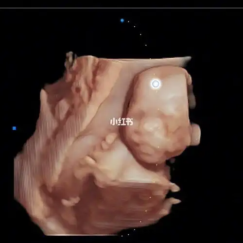 五维彩超20周宫内留影