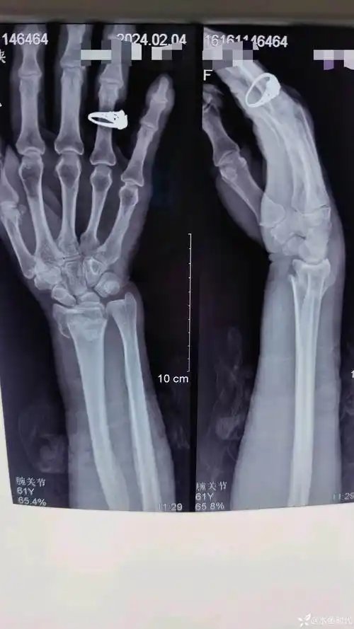各位老师看看这个colles骨折复位可以不