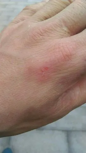 被一只泰迪宠物狗咬了一下要不要打破抗