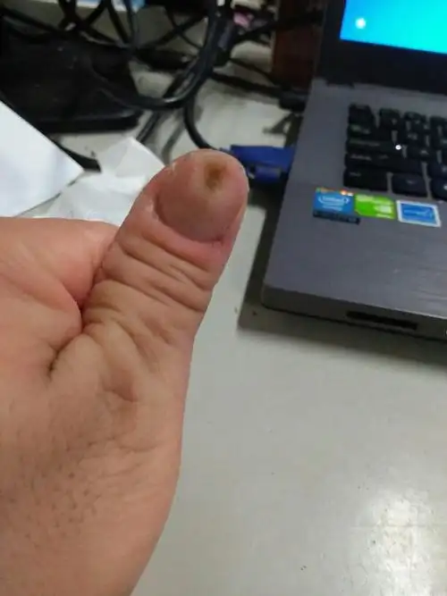 我的大拇指指甲上都是凹纹是怎么怎么回事?