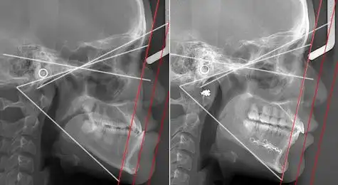 一个小测试就能看出是不是凸凸嘴