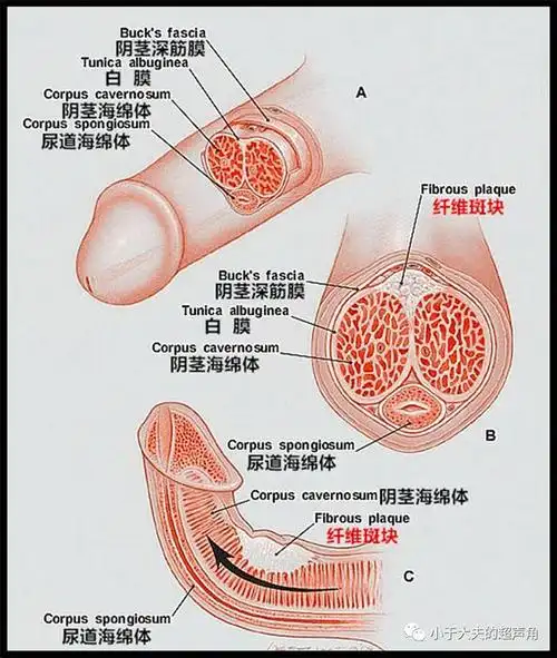 阴茎海棉体硬结症(阴茎纤维性海绵体炎),又称 peyronie氏病(peyronie