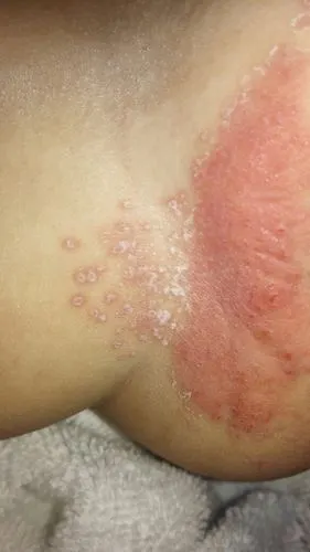 女儿八个月大,以前阴道两边红都是因为尿不湿用多了,湿疹,擦点防止红