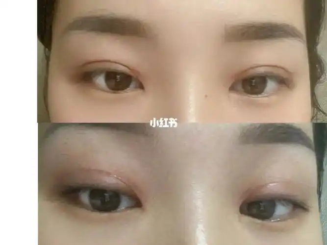 全切双眼皮  今天刚好40天了,眼角分叉,增生,很焦虑