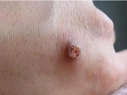 瘊子的最佳治疗方法