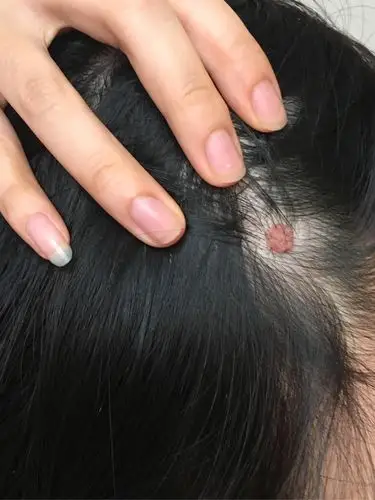 头皮上皮脂腺痣液氮冷冻,手术切除记录