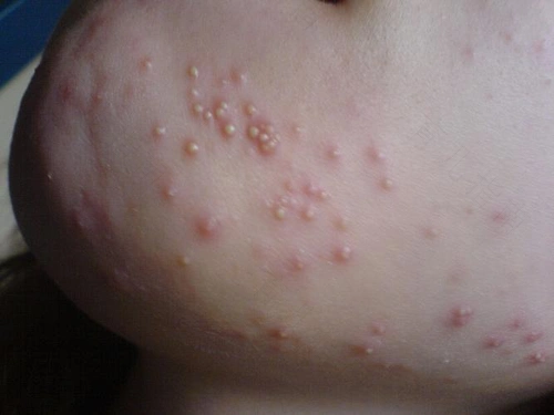 如何护理新生儿脓疱疮 新生儿脓疱疮的治疗及护理