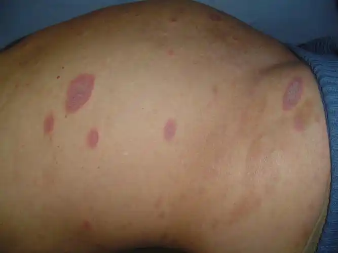 典型的扁平苔藓1例