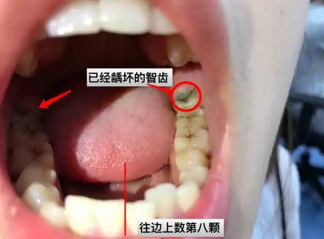 如何判断自己长智齿了教你一分钟自检智齿隐患