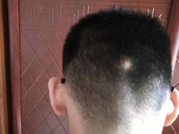 后脑勺有一块骨头突出,是反骨发育吗?摸起来略向后突出.18岁青年