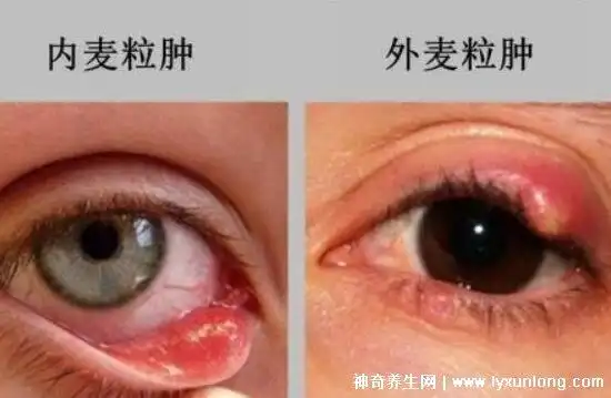 麦粒肿早期图片